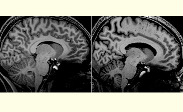 Hình ảnh chụp MRI não của bệnh nhân mắc COVID kéo dài (trái) và ME/CFS (phải). Nguồn: news.griffith.edu.au